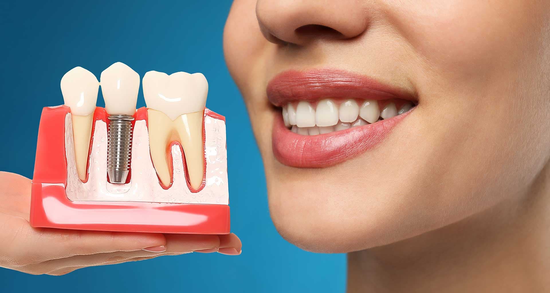 Are You a Candidate for Dental Implants? Here’s What to Know